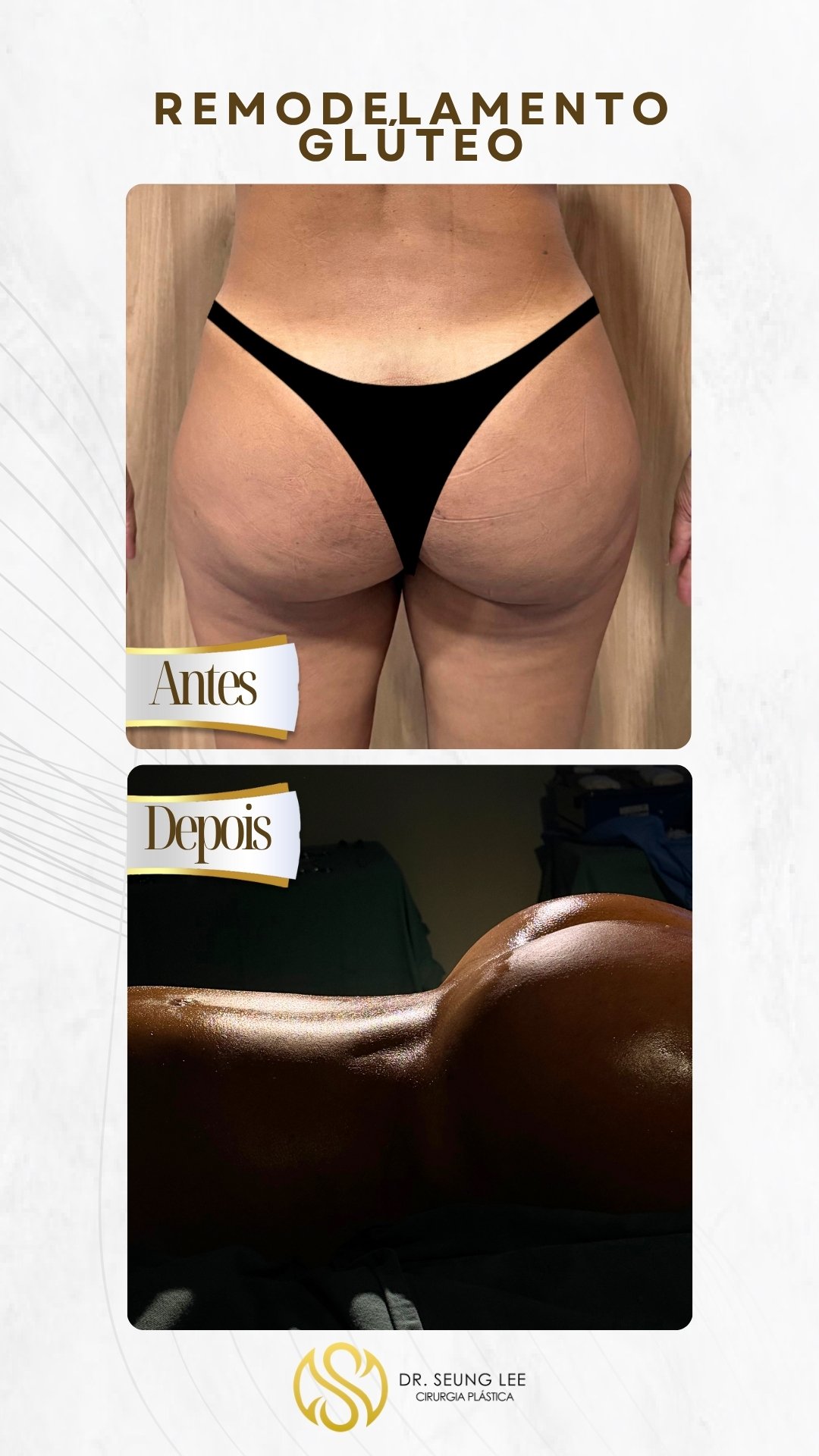 remodelamento-gluteo-2.jpg