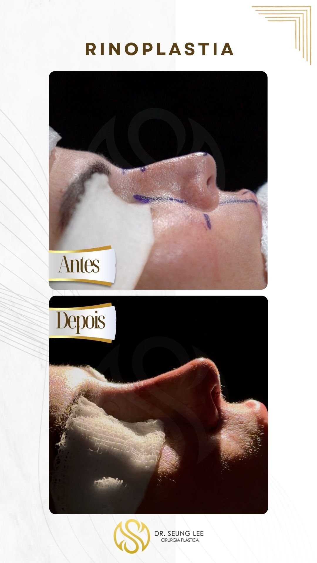 rinoplastia.jpg